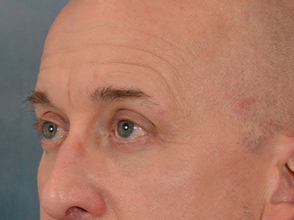 Eyelid Lift Before & After Gallery - Patient 605463 - Image 8