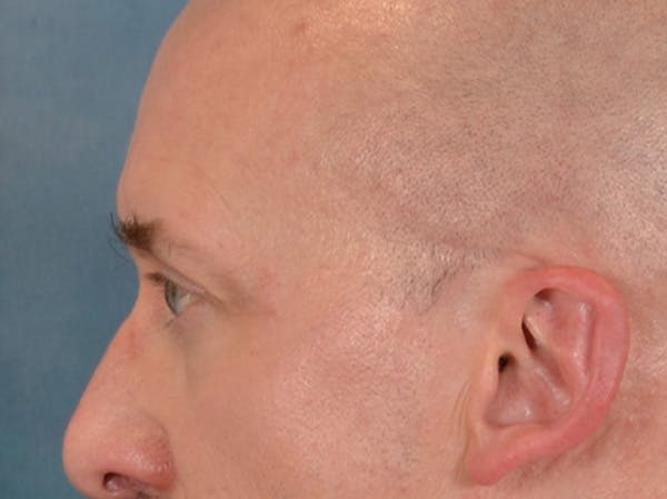 Eyelid Lift Before & After Gallery - Patient 605463 - Image 9