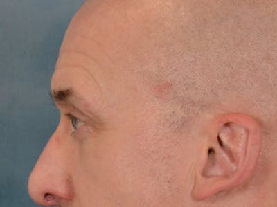 Eyelid Lift Before & After Gallery - Patient 605463 - Image 10