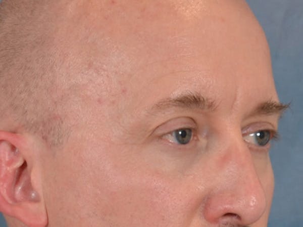 Eyelid Lift Before & After Gallery - Patient 605463 - Image 3