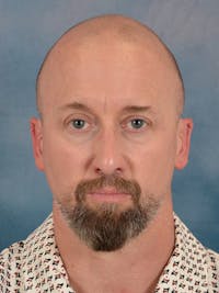 Laser Skin Resurfacing Before & After Gallery - Patient 648275 - Image 1