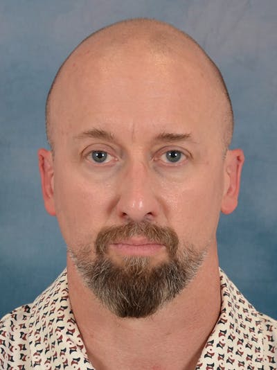 Laser Skin Resurfacing Before & After Gallery - Patient 648275 - Image 1