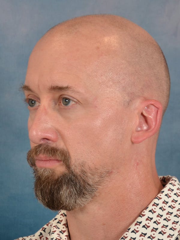 Laser Skin Resurfacing Before & After Gallery - Patient 648275 - Image 7