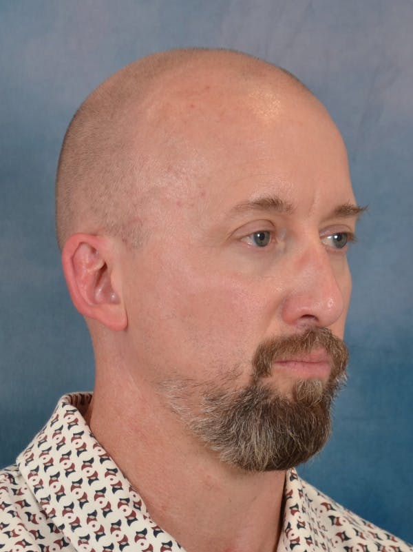 Laser Skin Resurfacing Before & After Gallery - Patient 648275 - Image 3