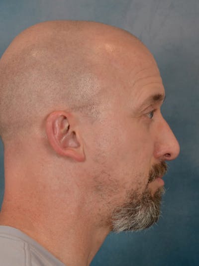 Laser Skin Resurfacing Before & After Gallery - Patient 648275 - Image 6