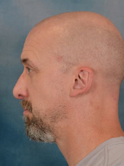 Laser Skin Resurfacing Before & After Gallery - Patient 648275 - Image 10