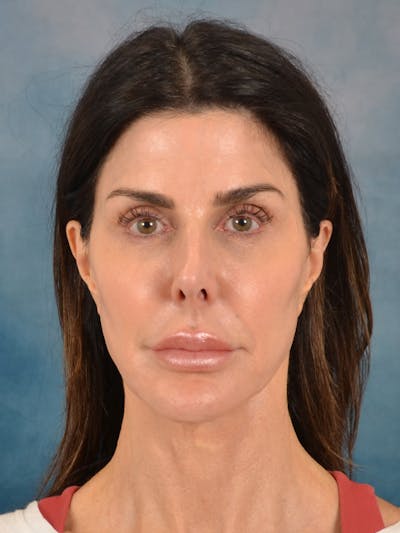 Laser Skin Resurfacing Before & After Gallery - Patient 131172 - Image 1