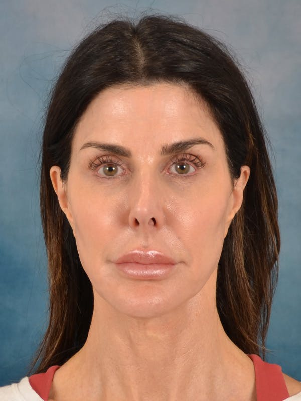 Laser Skin Resurfacing Before & After Gallery - Patient 131172 - Image 1
