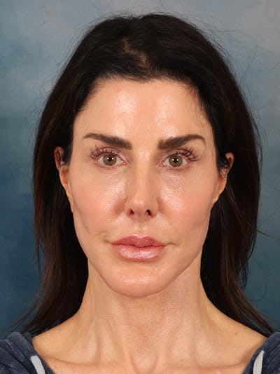 Laser Skin Resurfacing Before & After Gallery - Patient 131172 - Image 2
