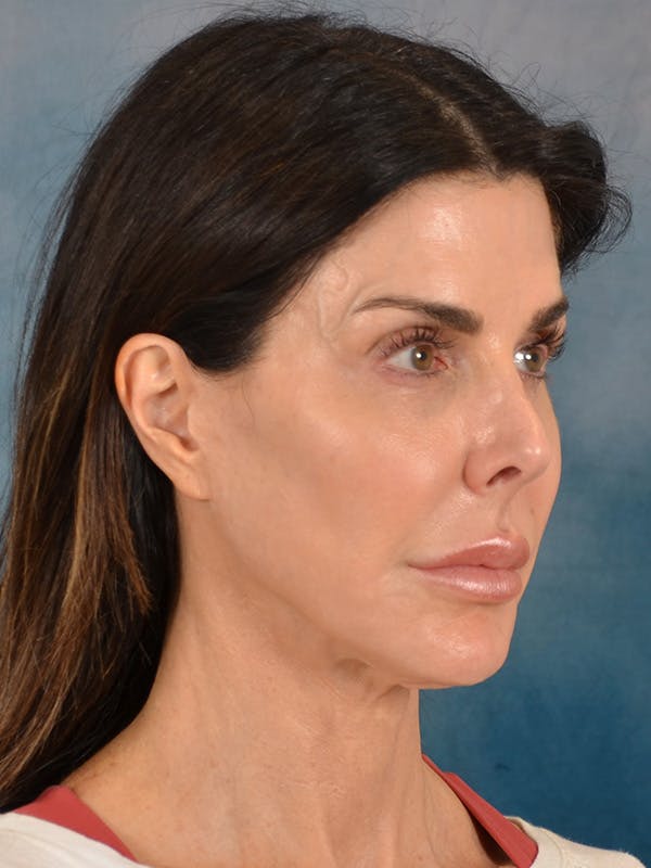Laser Skin Resurfacing Before & After Gallery - Patient 131172 - Image 7