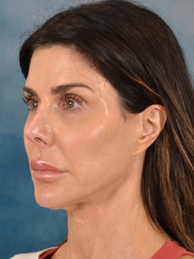 Deep Plane Facelift Before & After Gallery - Patient 316931 - Image 1