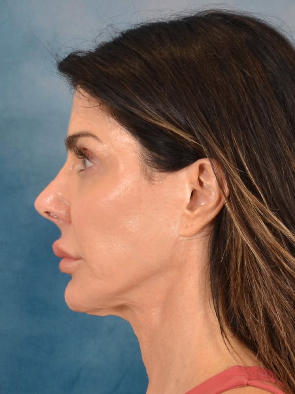 Laser Skin Resurfacing Before & After Gallery - Patient 131172 - Image 5