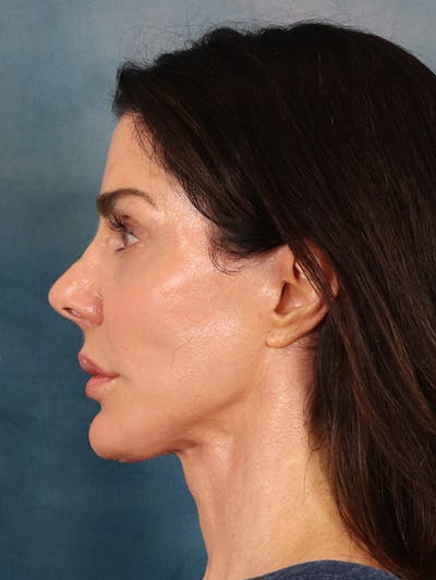 Laser Skin Resurfacing Before & After Gallery - Patient 131172 - Image 6