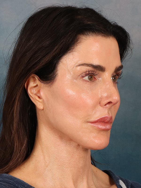 Laser Skin Resurfacing Before & After Gallery - Patient 131172 - Image 8