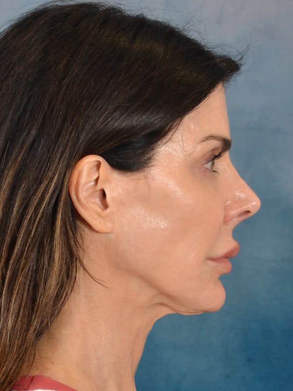 Laser Skin Resurfacing Before & After Gallery - Patient 131172 - Image 9