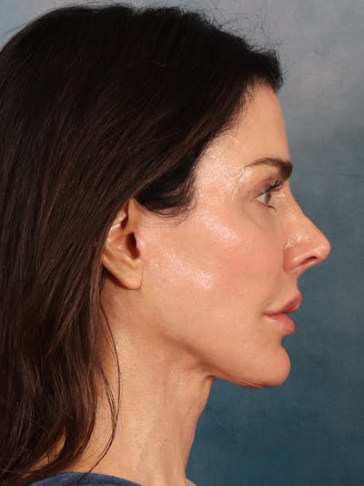 Laser Skin Resurfacing Before & After Gallery - Patient 131172 - Image 10