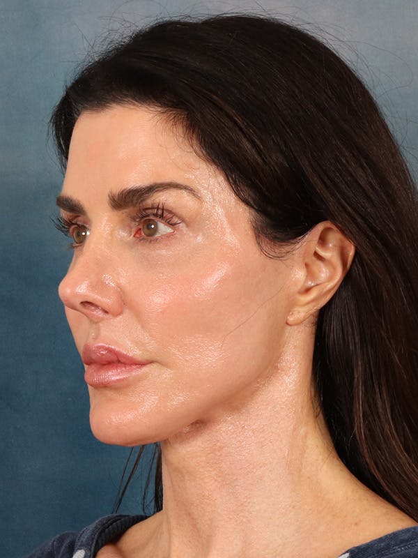 Laser Skin Resurfacing Before & After Gallery - Patient 131172 - Image 4