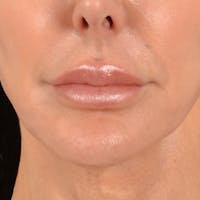 Lip Lift Before & After Gallery - Patient 324298 - Image 1