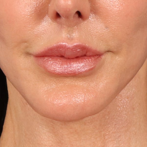 Lip Lift Before & After Gallery - Patient 324298 - Image 2