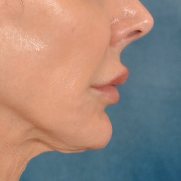 Lip Lift Before & After Gallery - Patient 324298 - Image 5