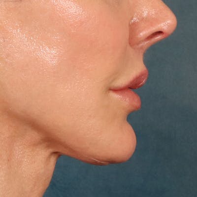 Lip Lift Before & After Gallery - Patient 324298 - Image 6