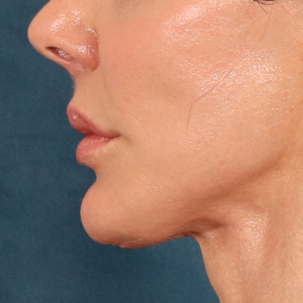 Lip Lift Before & After Gallery - Patient 324298 - Image 10