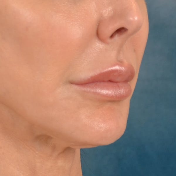 Lip Lift Before & After Gallery - Patient 324298 - Image 3