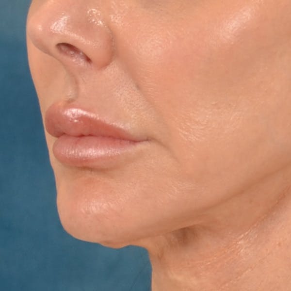 Lip Lift Before & After Gallery - Patient 324298 - Image 7