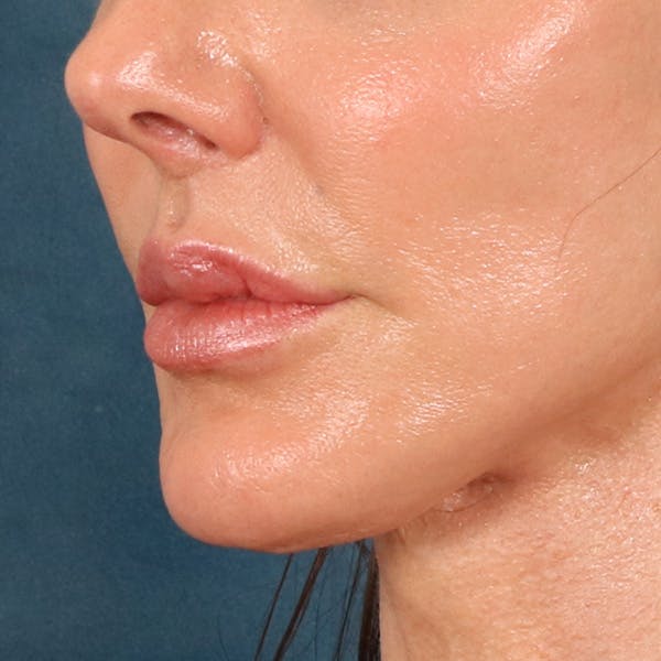 Lip Lift Before & After Gallery - Patient 324298 - Image 8