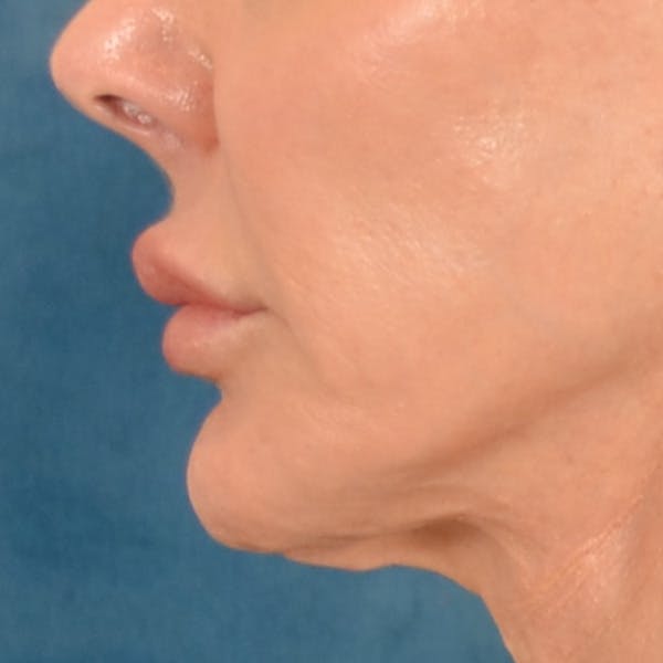 Lip Lift Before & After Gallery - Patient 324298 - Image 9