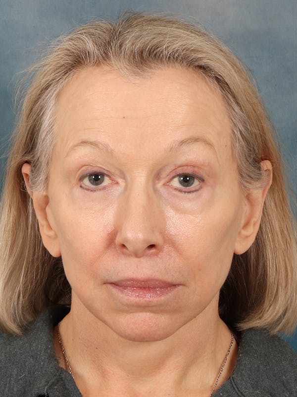 Deep Neck Lift Before & After Gallery - Patient 247096 - Image 2