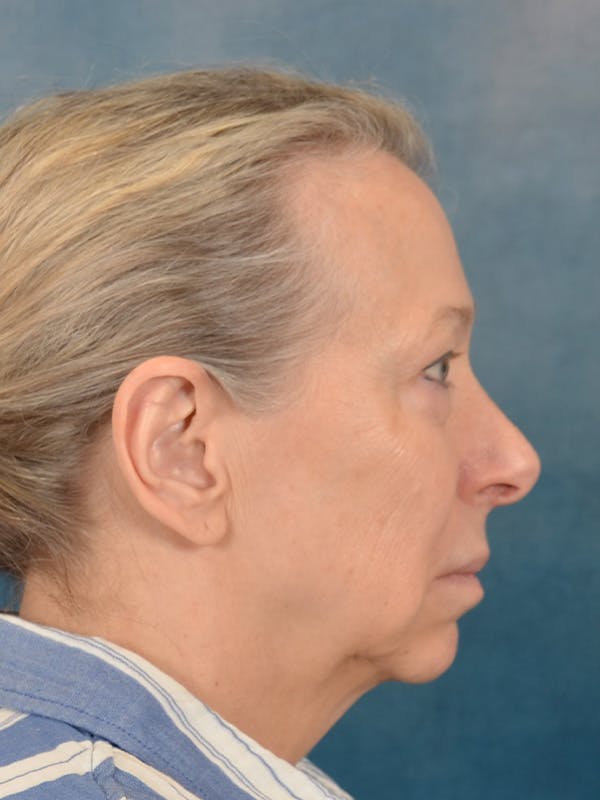 Deep Neck Lift Before & After Gallery - Patient 247096 - Image 9