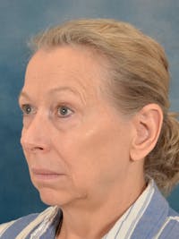 Deep Plane Facelift Before & After Gallery - Patient 148969 - Image 1