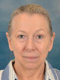 Deep Neck Lift Before & After Gallery - Patient 247096 - Image 1