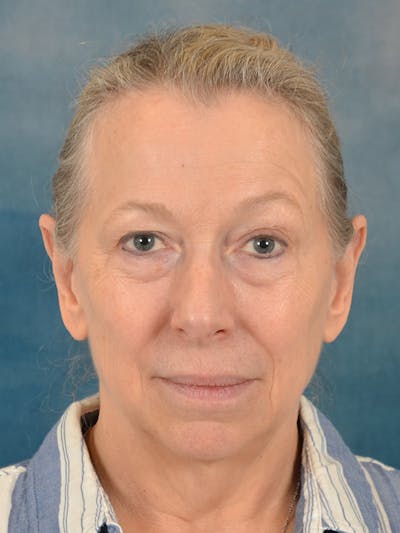 Laser Skin Resurfacing Before & After Gallery - Patient 344340 - Image 1