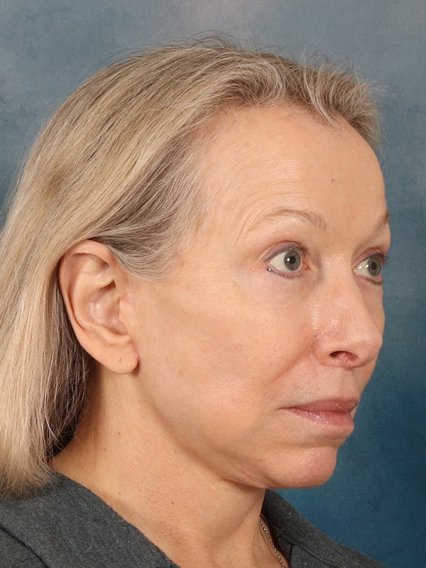 Deep Neck Lift Before & After Gallery - Patient 247096 - Image 8