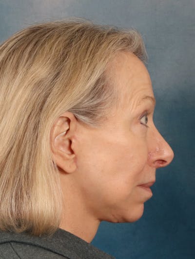 Deep Neck Lift Before & After Gallery - Patient 247096 - Image 10