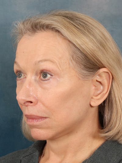 Deep Neck Lift Before & After Gallery - Patient 247096 - Image 4