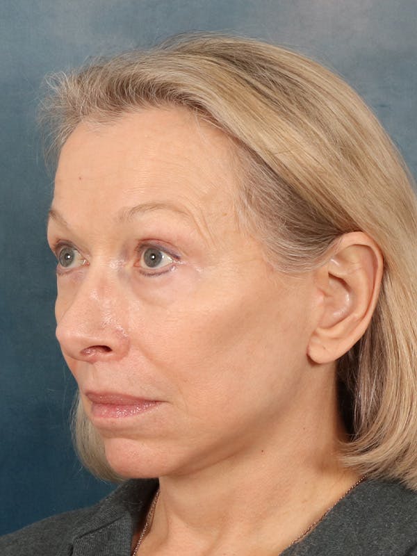 Deep Neck Lift Before & After Gallery - Patient 247096 - Image 4
