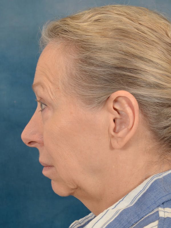 Deep Neck Lift Before & After Gallery - Patient 247096 - Image 5