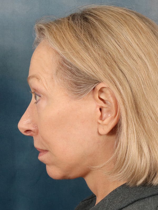 Deep Neck Lift Before & After Gallery - Patient 247096 - Image 6