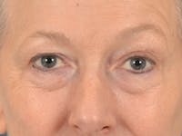 Eyelid Lift Before & After Gallery - Patient 319200 - Image 1