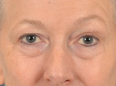 Eyelid Lift Before & After Gallery - Patient 319200 - Image 1