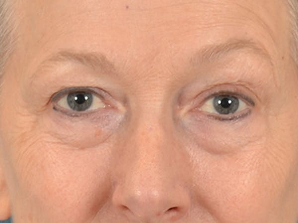 Eyelid Lift Before & After Gallery - Patient 319200 - Image 1