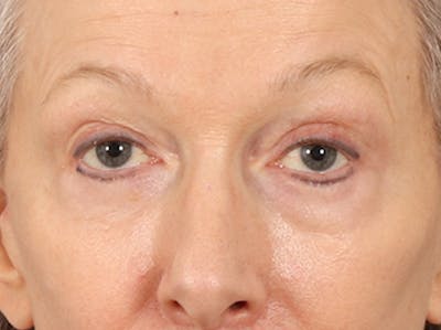 Eyelid Lift Before & After Gallery - Patient 319200 - Image 2