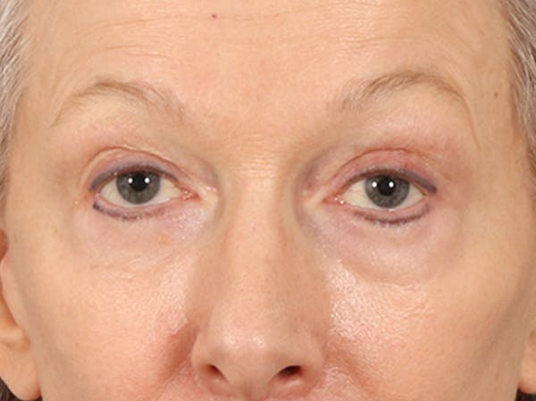 Eyelid Lift Before & After Gallery - Patient 319200 - Image 2