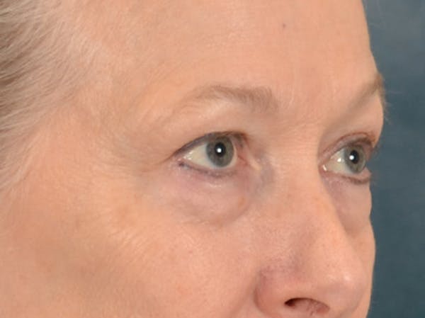 Eyelid Lift Before & After Gallery - Patient 319200 - Image 3