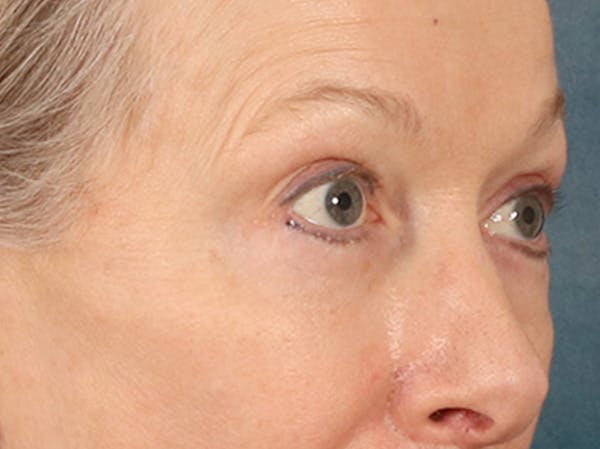 Eyelid Lift Before & After Gallery - Patient 319200 - Image 4