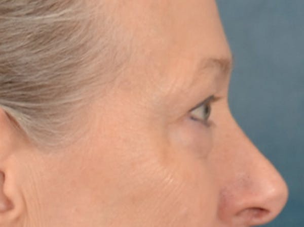Eyelid Lift Before & After Gallery - Patient 319200 - Image 5