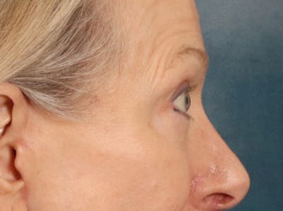 Eyelid Lift Before & After Gallery - Patient 319200 - Image 6